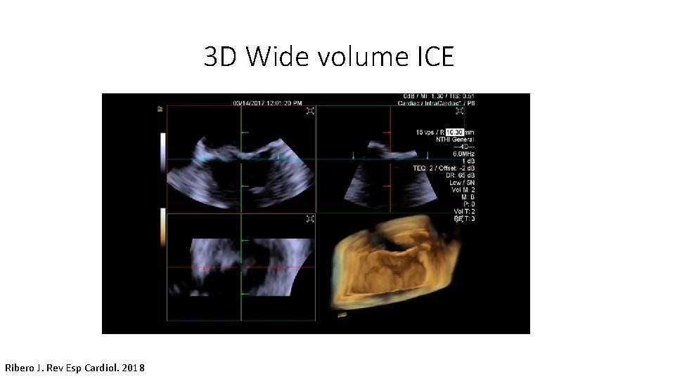 3 D Wide volume ICE Ribero J. Rev Esp Cardiol. 2018 