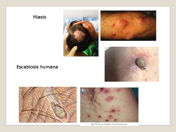Miasis Escabiosis humana 