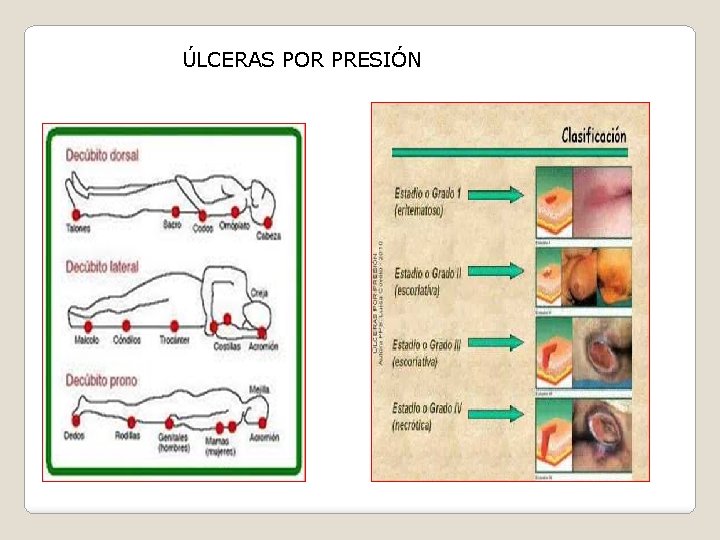 ÚLCERAS POR PRESIÓN 