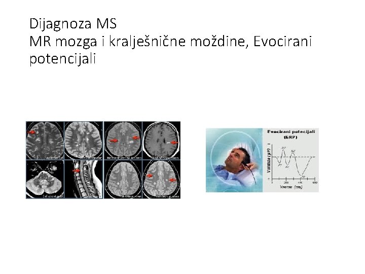 Dijagnoza MS MR mozga i kralješnične moždine, Evocirani potencijali 