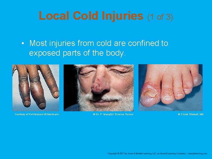 Local Cold Injuries (1 of 3) • Most injuries from cold are confined to