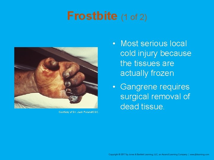 Frostbite (1 of 2) • Most serious local cold injury because the tissues are