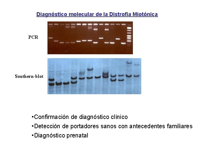 Diagnóstico molecular de la Distrofia Miotónica PCR Southern-blot • Confirmación de diagnóstico clínico •