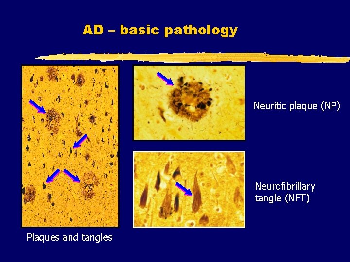 AD – basic pathology Neuritic plaque (NP) Neurofibrillary tangle (NFT) Plaques and tangles 