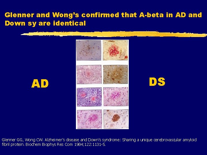 Glenner and Wong’s confirmed that A-beta in AD and Down sy are identical AD