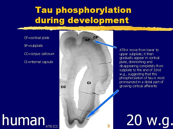 Tau phosphorylation during development CP=cortical plate SP=subplate CC=corpus callosum CI=internal capsule human AT 8