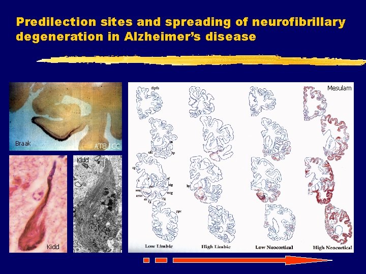 Predilection sites and spreading of neurofibrillary degeneration in Alzheimer’s disease Mesulam Braak AT 8