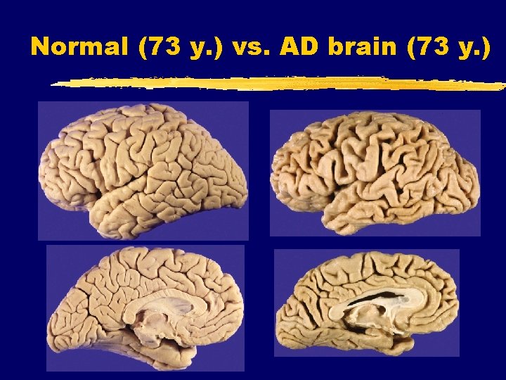Normal (73 y. ) vs. AD brain (73 y. ) 