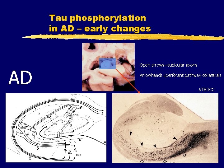 Tau phosphorylation in AD – early changes AD Open arrows=subicular axons Arrowheads=perforant pathway collaterals