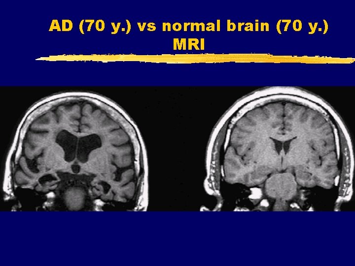 AD (70 y. ) vs normal brain (70 y. ) MRI 