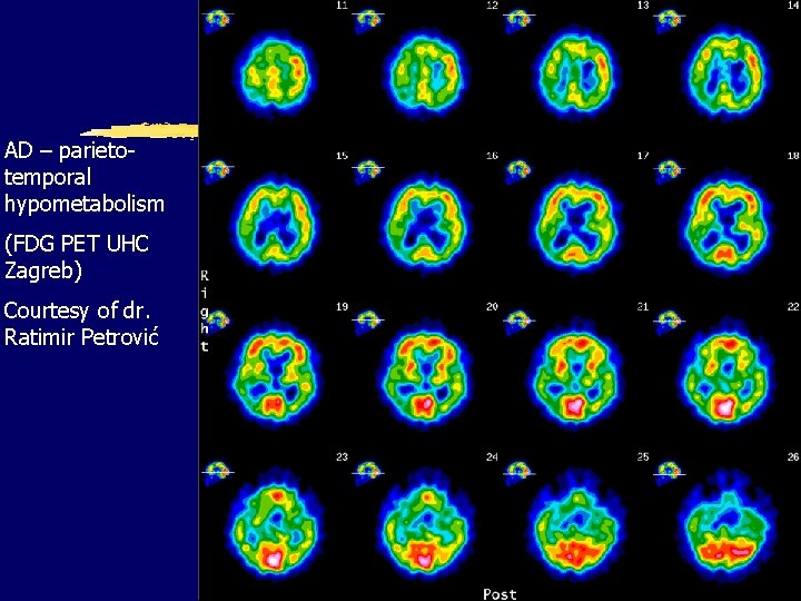 AD – parietotemporal hypometabolism (FDG PET UHC Zagreb) Courtesy of dr. Ratimir Petrović 