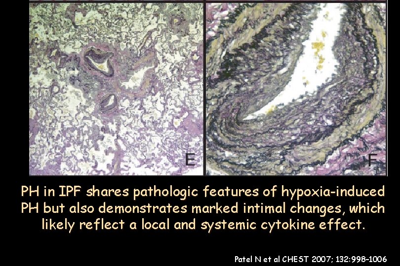 (n 376) bronchiole-vascular bundle in in aanlobule area medial +medial intimalthickening +elastic tissue Pulmonary