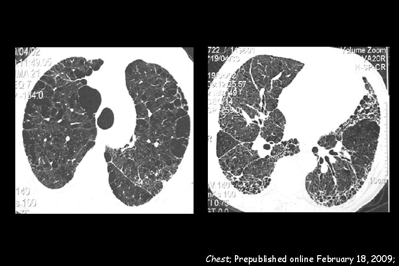 Chest; Prepublished online February 18, 2009; 