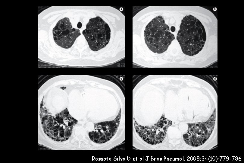 Rossato Silva D et al J Bras Pneumol. 2008; 34(10): 779 -786 