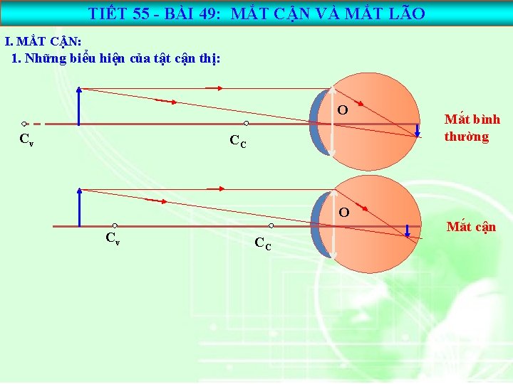 TIẾT 55 - BÀI 49: MẮT CẬN VÀ MẮT LÃO I. MẮT CẬN: 1.