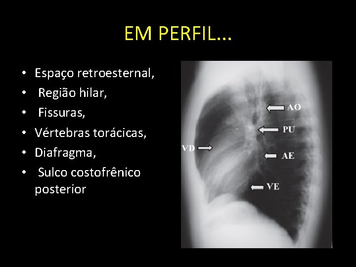 EM PERFIL. . . • • • Espaço retroesternal, Região hilar, Fissuras, Vértebras torácicas,