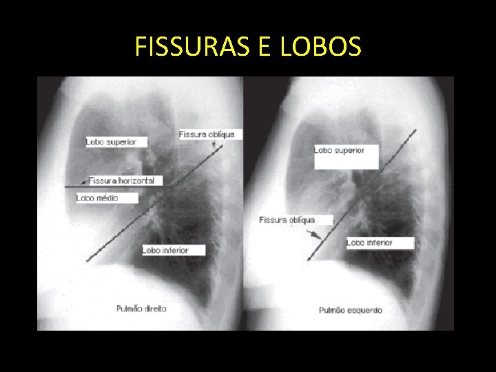 FISSURAS E LOBOS 