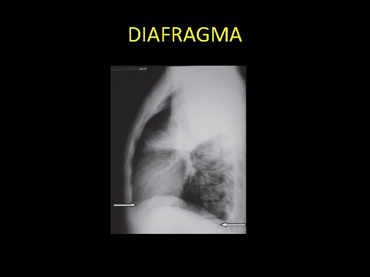 DIAFRAGMA 