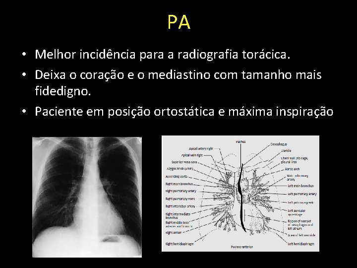 PA • Melhor incidência para a radiografia torácica. • Deixa o coração e o