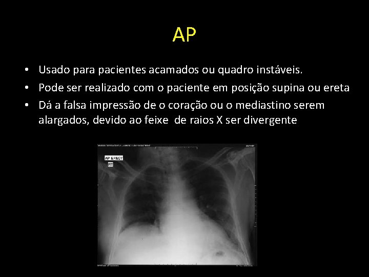 AP • Usado para pacientes acamados ou quadro instáveis. • Pode ser realizado com