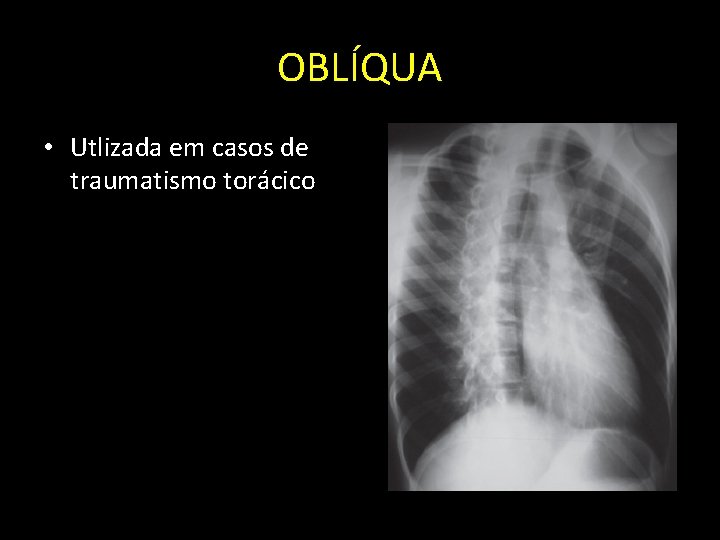 OBLÍQUA • Utlizada em casos de traumatismo torácico 