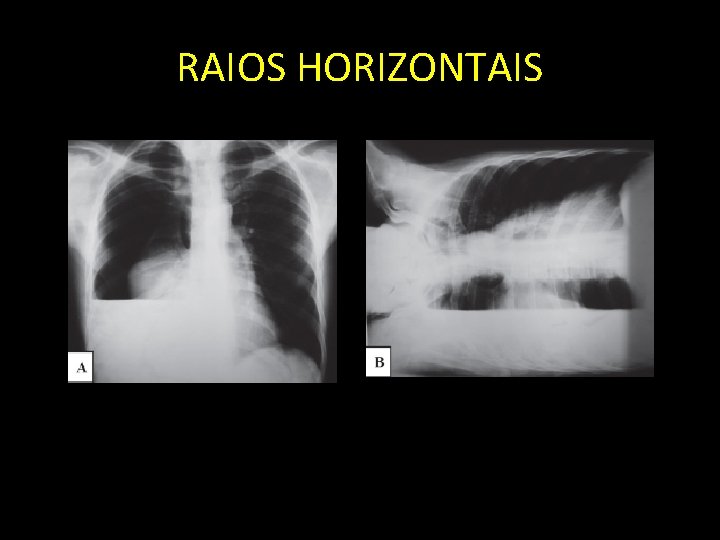 RAIOS HORIZONTAIS 