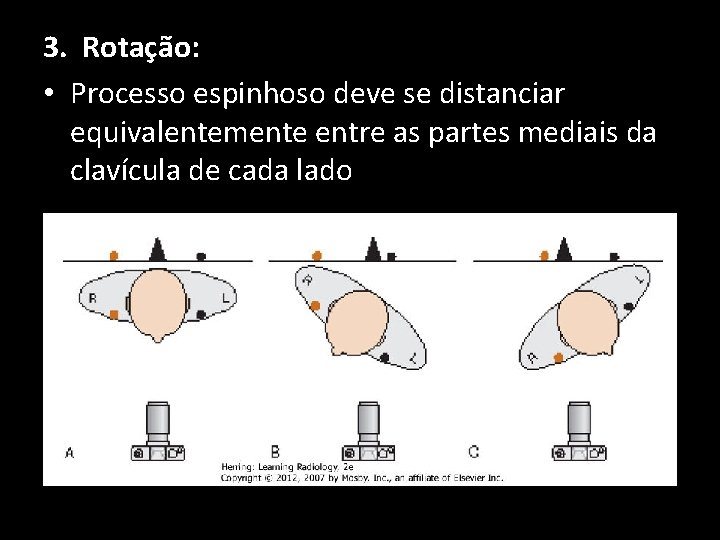 3. Rotação: • Processo espinhoso deve se distanciar equivalentemente entre as partes mediais da