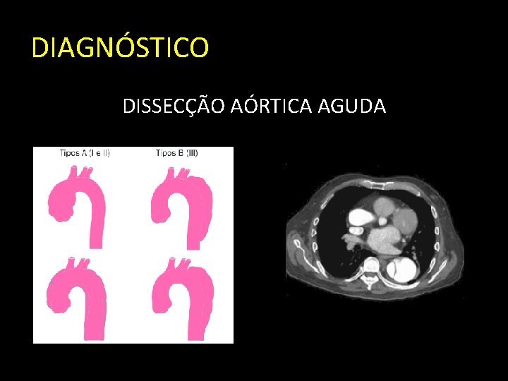 DIAGNÓSTICO DISSECÇÃO AÓRTICA AGUDA 