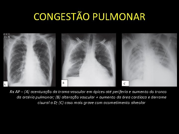 CONGESTÃO PULMONAR Rx AP – (A) acentuação da trama vascular em ápices até periferia