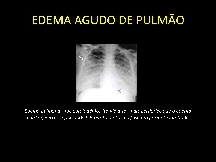 EDEMA AGUDO DE PULMÃO Edema pulmonar não cardiogênico (tende a ser mais periférico que