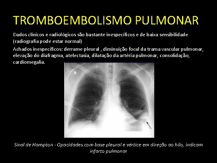 TROMBOEMBOLISMO PULMONAR Dados clínicos e radiológicos são bastante inespecíficos e de baixa sensibilidade (radiografia