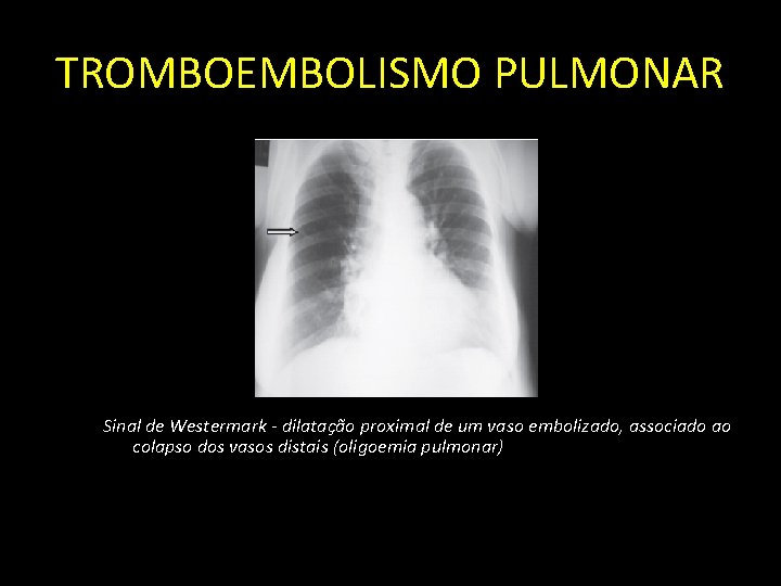 TROMBOEMBOLISMO PULMONAR Sinal de Westermark - dilatação proximal de um vaso embolizado, associado ao