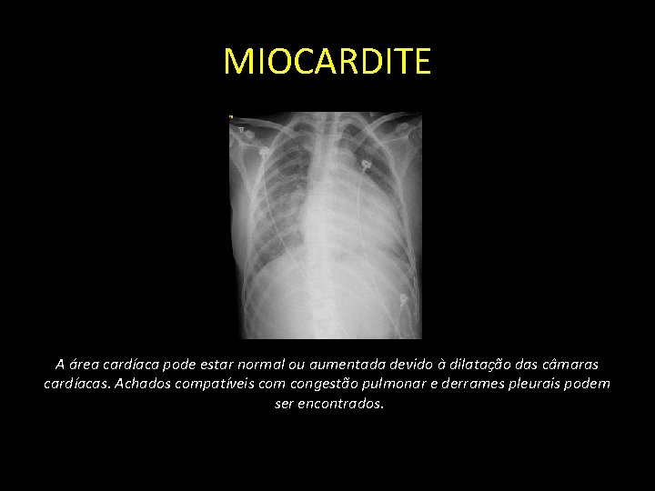 MIOCARDITE A área cardíaca pode estar normal ou aumentada devido à dilatação das câmaras