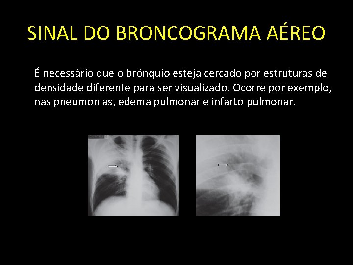 SINAL DO BRONCOGRAMA AÉREO É necessário que o brônquio esteja cercado por estruturas de