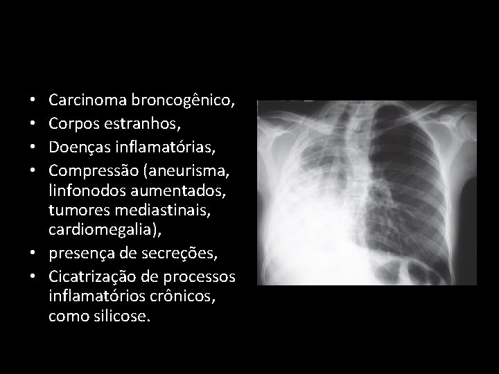 Carcinoma broncogênico, Corpos estranhos, Doenças inflamatórias, Compressão (aneurisma, linfonodos aumentados, tumores mediastinais, cardiomegalia), •