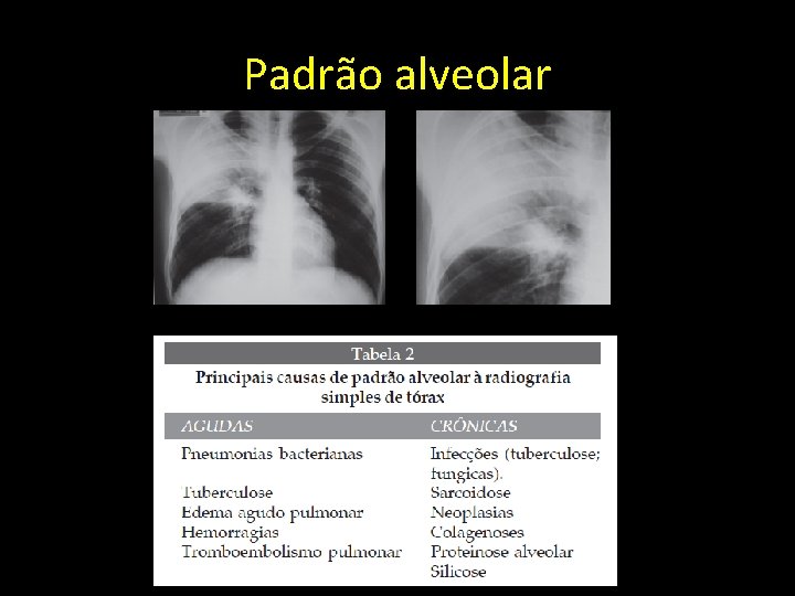 Padrão alveolar 