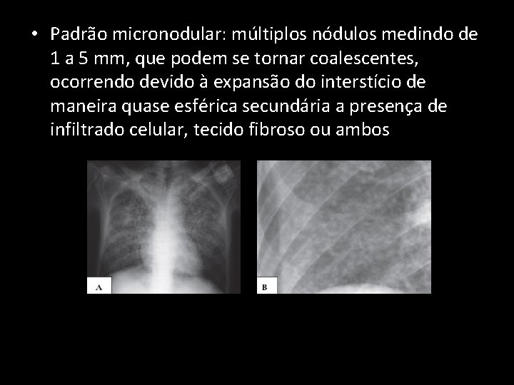  • Padrão micronodular: múltiplos nódulos medindo de 1 a 5 mm, que podem