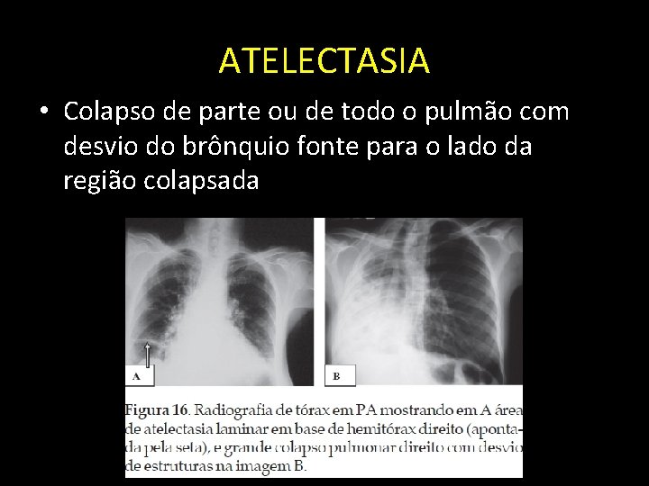 ATELECTASIA • Colapso de parte ou de todo o pulmão com desvio do brônquio