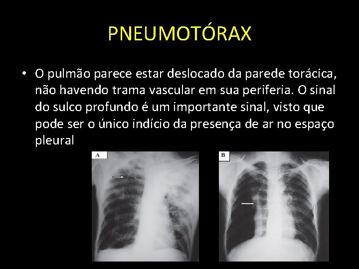 PNEUMOTÓRAX • O pulmão parece estar deslocado da parede torácica, não havendo trama vascular