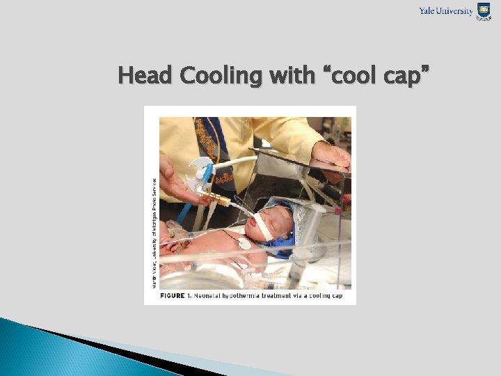 Head Cooling with “cool cap” 