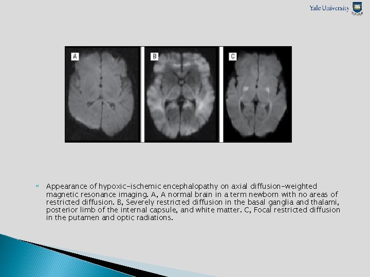  Appearance of hypoxic-ischemic encephalopathy on axial diffusion-weighted magnetic resonance imaging. A, A normal