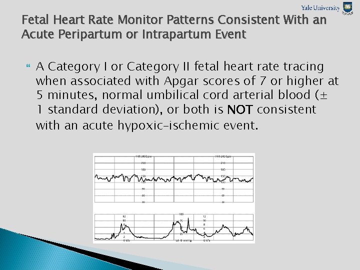 Fetal Heart Rate Monitor Patterns Consistent With an Acute Peripartum or Intrapartum Event A