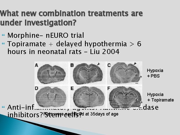 What new combination treatments are under investigation? Morphine- n. EURO trial Topiramate + delayed