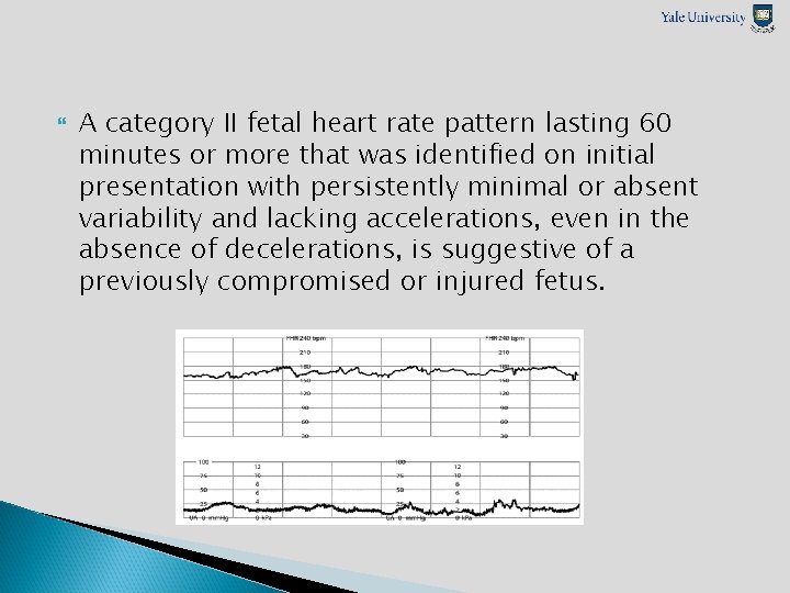  A category II fetal heart rate pattern lasting 60 minutes or more that
