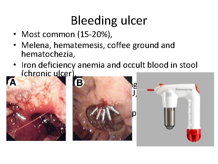 Bleeding ulcer • Most common (15 -20%), • Melena, hematemesis, coffee ground and hematochezia, Bleeding ulcer • Most common (15 -20%), • Melena, hematemesis, coffee ground and hematochezia,
