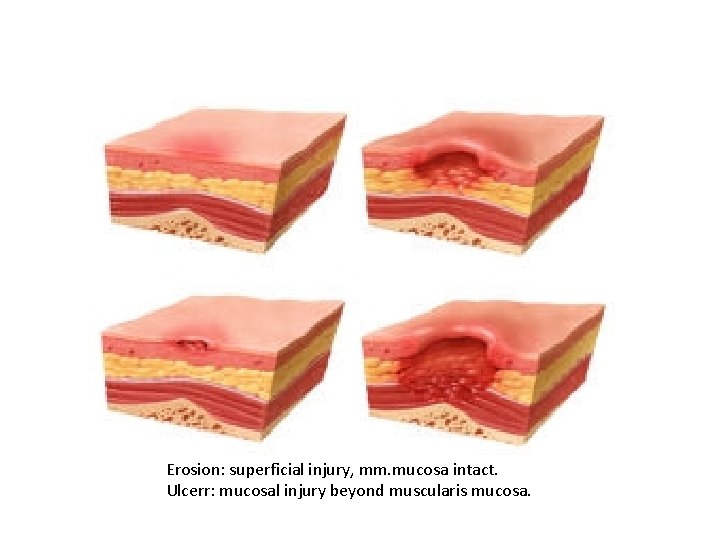 Erosion: superficial injury, mm. mucosa intact. Ulcerr: mucosal injury beyond muscularis mucosa. Erosion: superficial injury, mm. mucosa intact. Ulcerr: mucosal injury beyond muscularis mucosa.