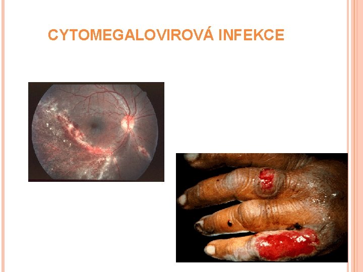 CYTOMEGALOVIROVÁ INFEKCE 