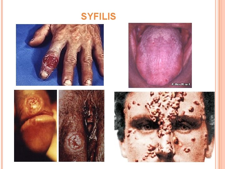 SYFILIS 