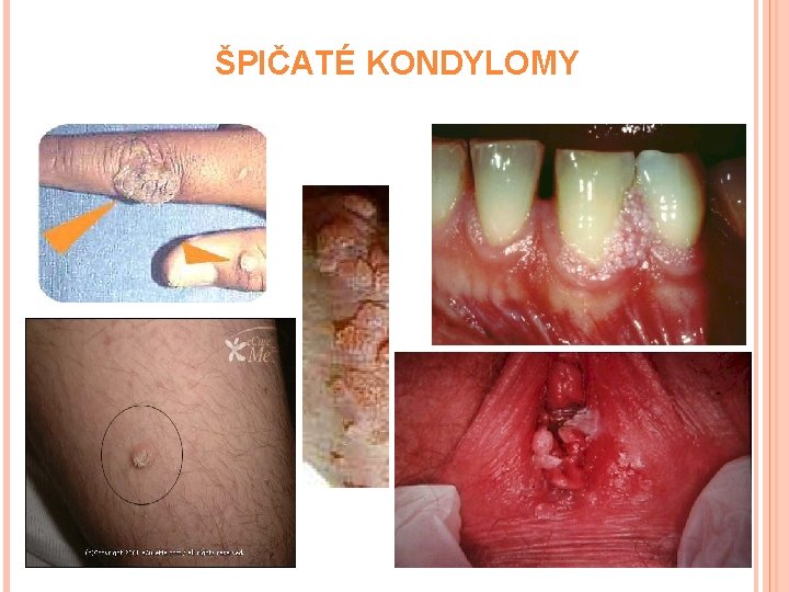  ŠPIČATÉ KONDYLOMY 