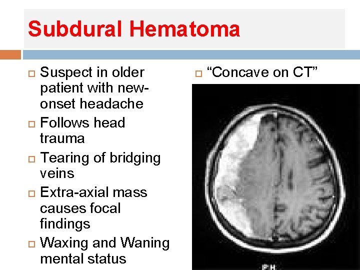 Subdural Hematoma Suspect in older patient with newonset headache Follows head trauma Tearing of Subdural Hematoma Suspect in older patient with newonset headache Follows head trauma Tearing of